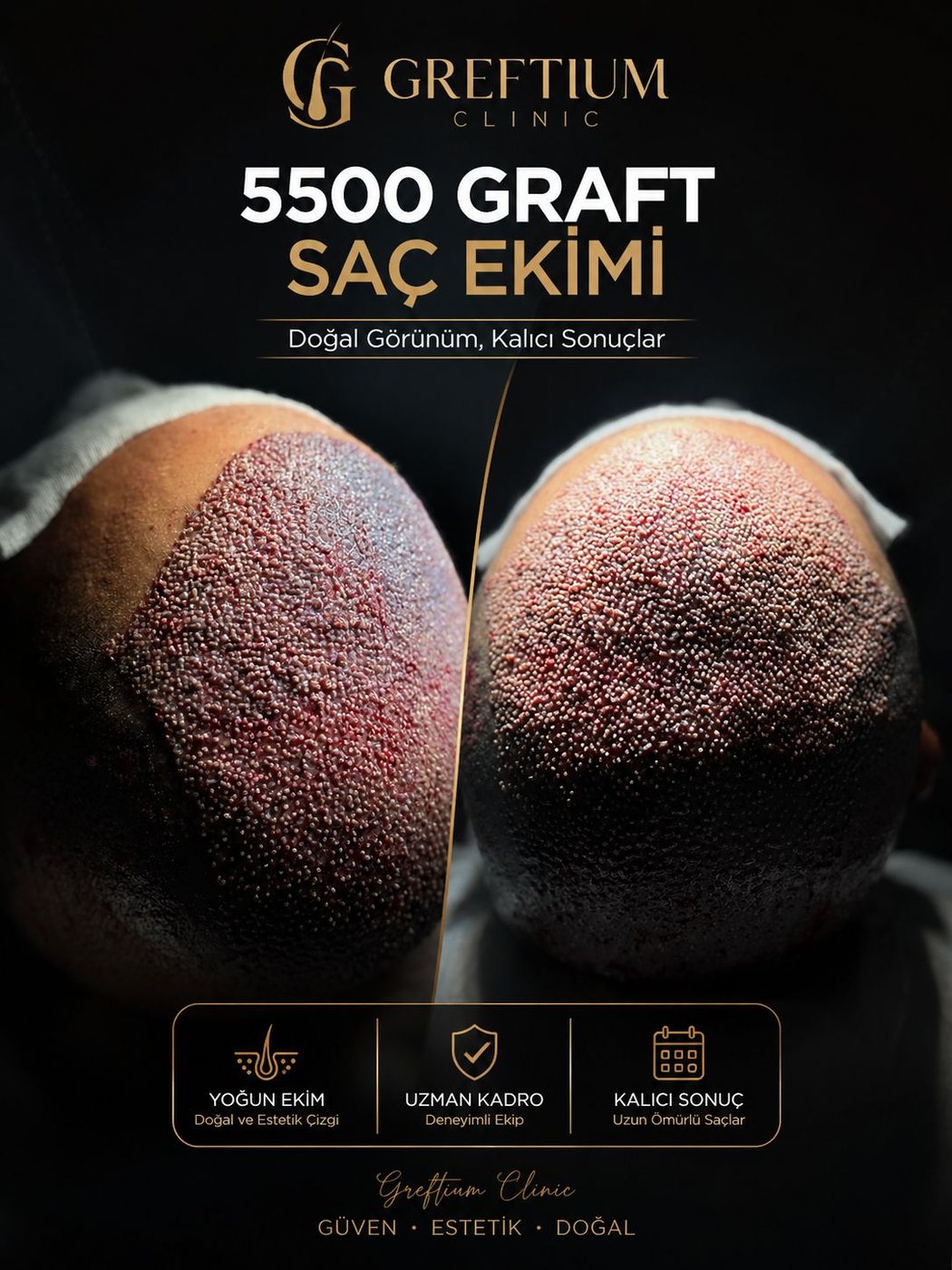 GREFTIUM CLINIC 5500 greft saç ekimi öncesi sonrası