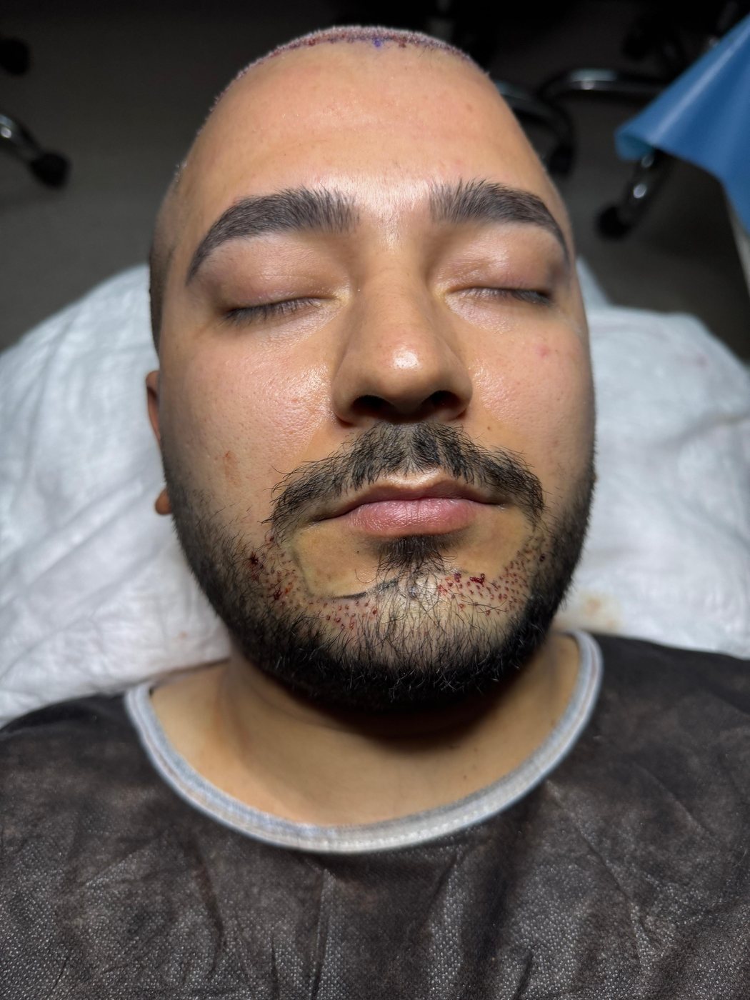GREFTIUM CLINIC saç ekimi operasyon karesi