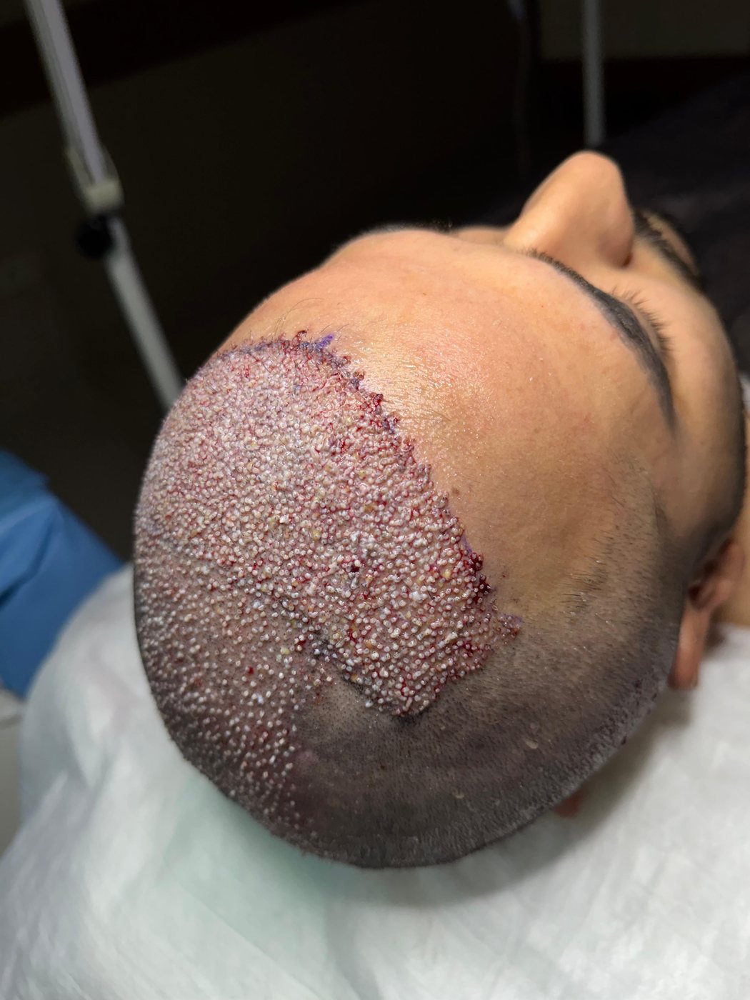 GREFTIUM CLINIC saç ekimi operasyon karesi