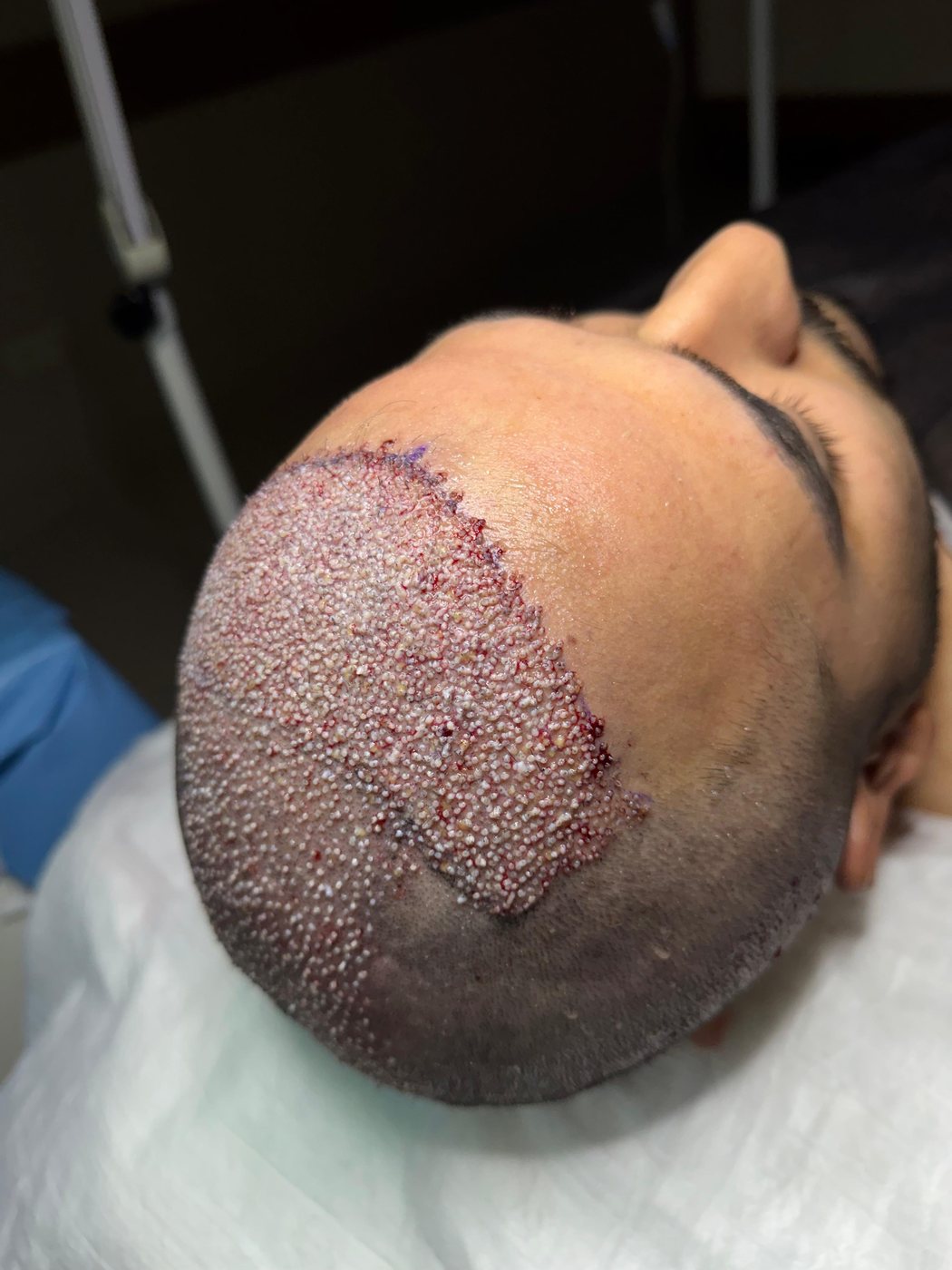 GREFTIUM CLINIC saç ekimi operasyon karesi