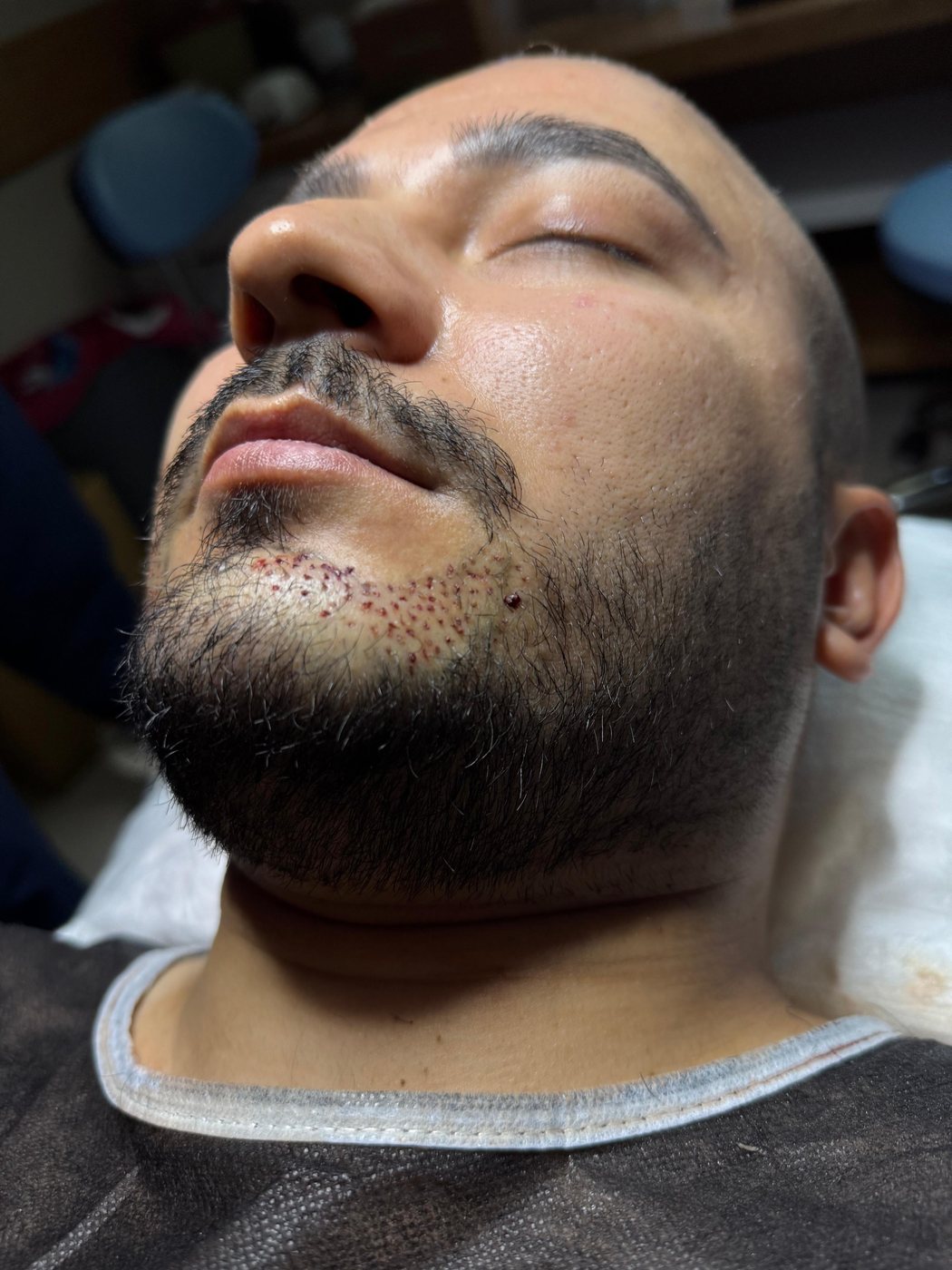 GREFTIUM CLINIC saç ekimi operasyon karesi