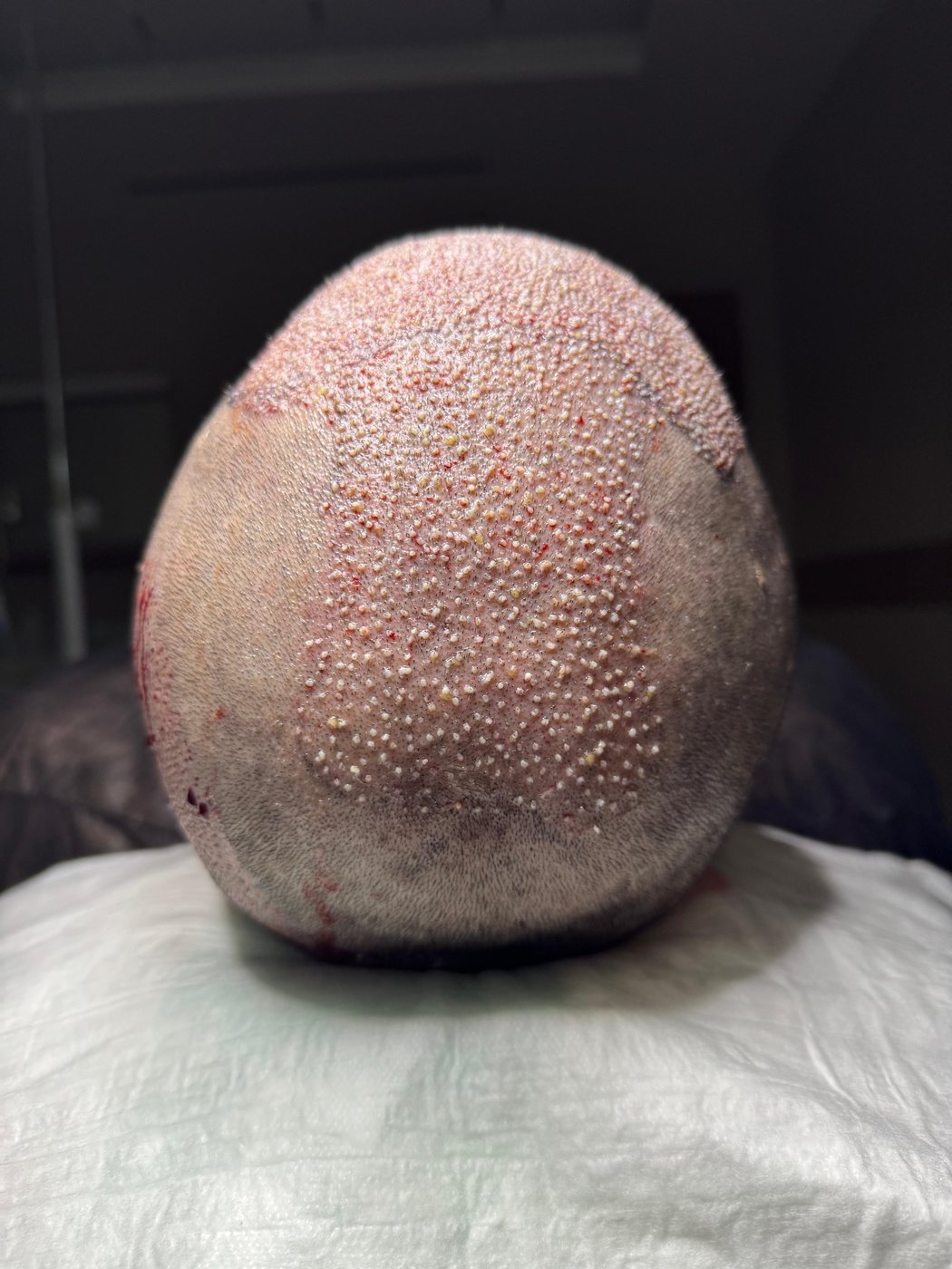 GREFTIUM CLINIC saç ekimi operasyon karesi