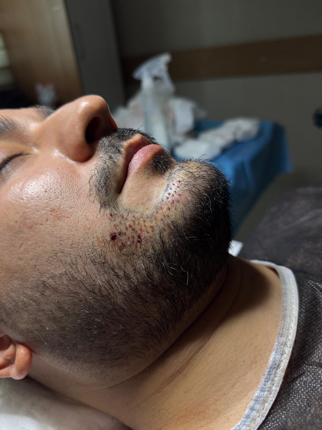 GREFTIUM CLINIC saç ekimi operasyon karesi