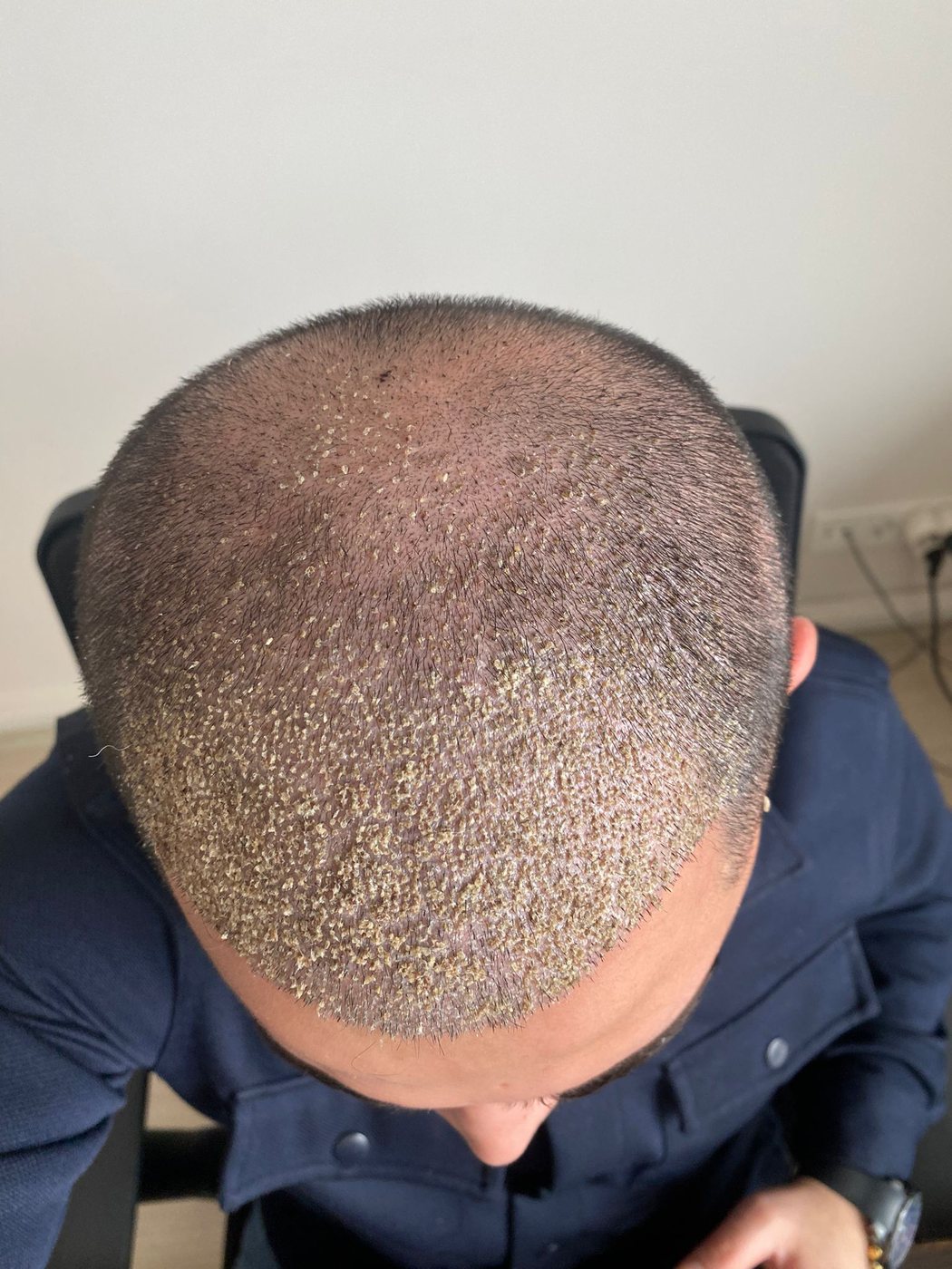 Saç ekimi sonrası kabuk dökümü — GREFTIUM CLINIC