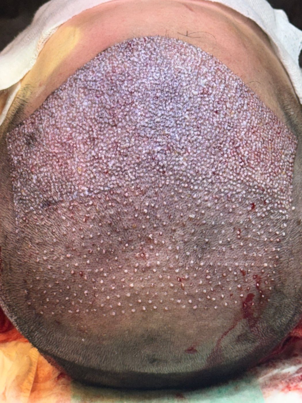 Saç ekimi sonrası kabuk dökümü — GREFTIUM CLINIC