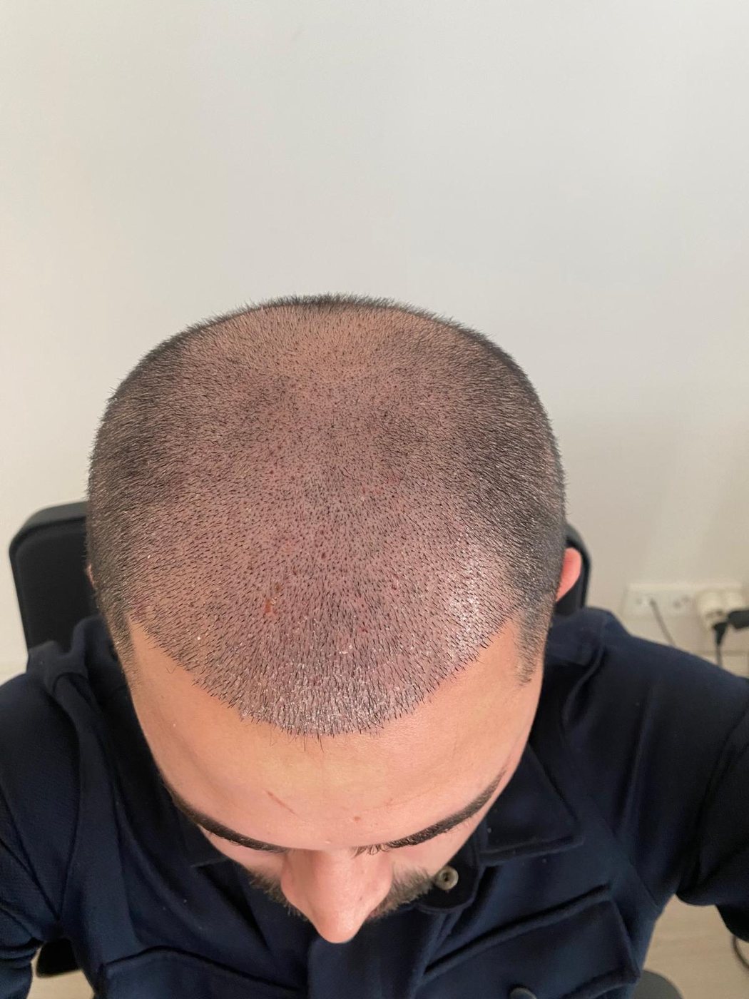 Saç ekimi sonrası kabuk dökümü — GREFTIUM CLINIC